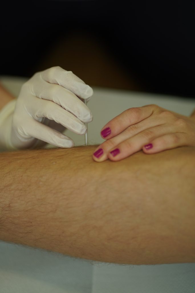Dry needling