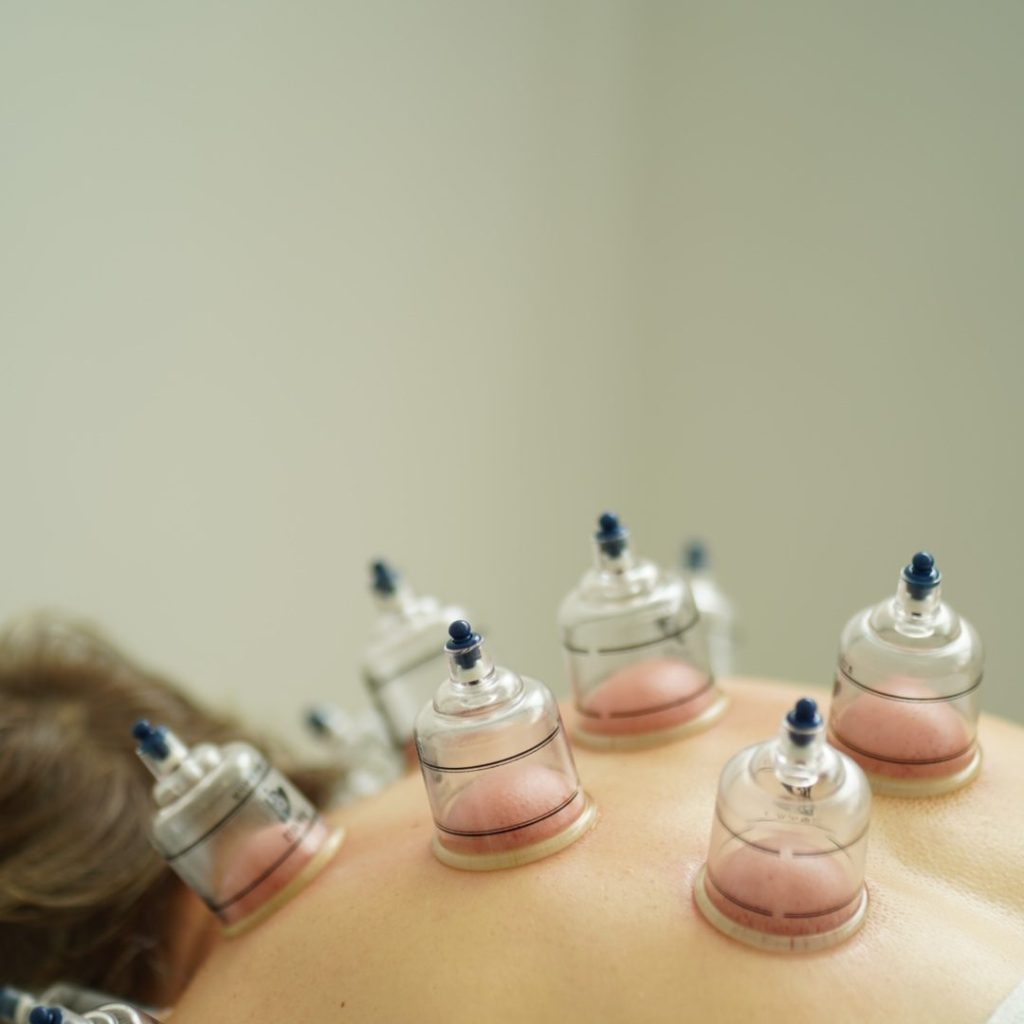 Cupping masaža